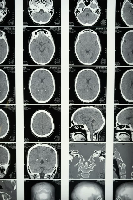 MRI scans of brain