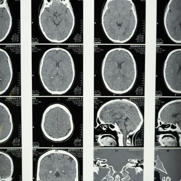 MRI scans of brain